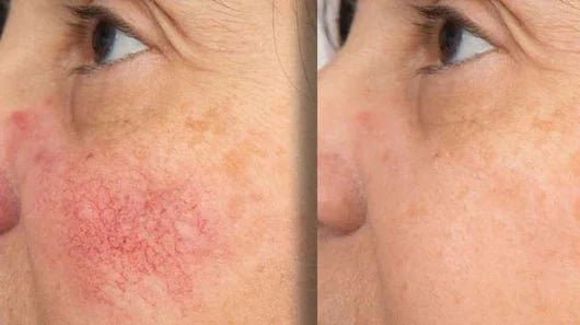Solvia Sérum Anti - Rojeces - Solvia IT