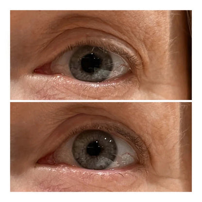Varita Lifting de Ojos - Solvia IT