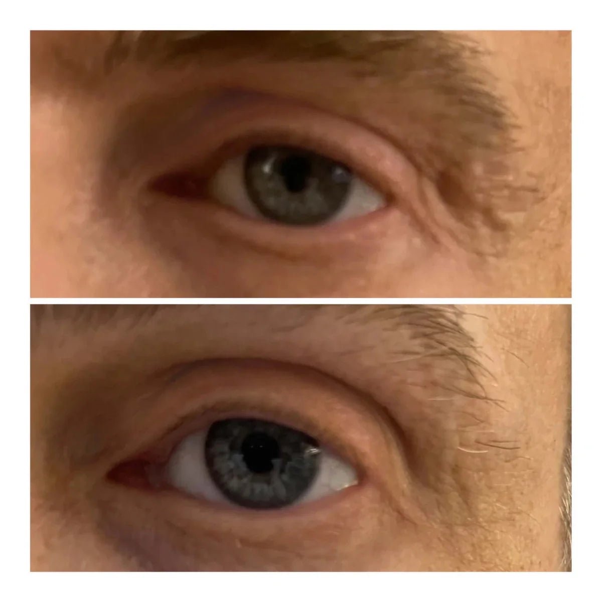 Varita Lifting de Ojos - Solvia IT